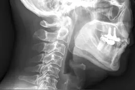 拔鱼刺，中国医生是最强的图片