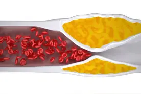 有斑块不用怕，把血管斑块“缩”回去！做好4点，多数人很有效图片