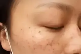 中老年朋友出现“色素沉着”和斑点不要急，试试这些方法改善。图片