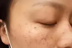 中老年朋友出现“色素沉着”和斑点不要急，试试这些方法改善。图片