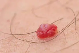 身上出现小红点，就说明是肝硬化吗？关键是认清这两点图片