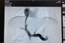 肝腹水是怎么回事？TIPS对消化道出血和腹水的效果怎么样？图片