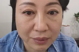眼袋脂肪是“不可再生资源”？三甲医生教你这样祛眼袋，不踩坑图片