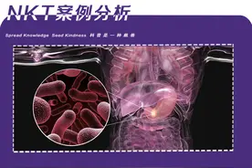 2年前被查出胃印戒细胞癌，现在还好吗？图片