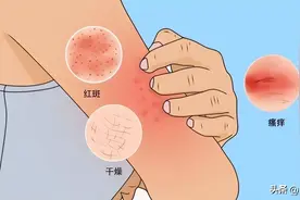 皮肤病的根多在湿！一味药强效祛湿，横扫湿疹，荨麻疹 皮肤瘙痒图片