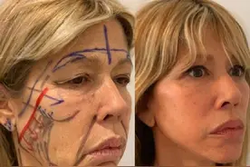 拉皮手术这个医美项目，谁做谁后悔？医生说出真相图片