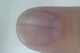 ​警惕「夺命」线｜指甲长“黑线”是怎么回事？图片