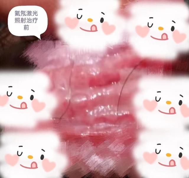 “丁头”发“炎”怎么办？—氦氖激光照射治疗为您排忧解“男”