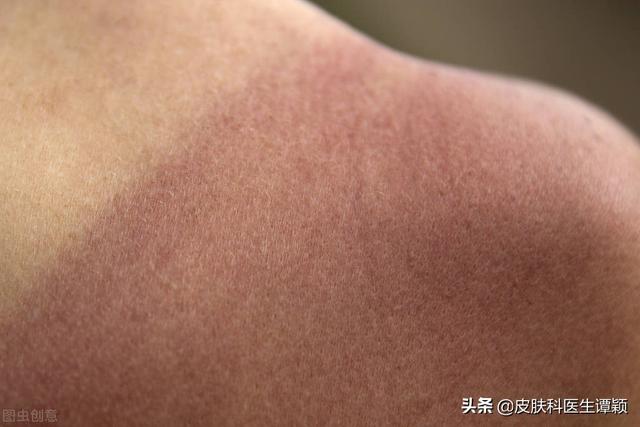 紫外线照射能治疗鸡皮肤吗