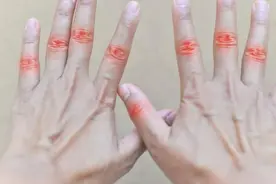 痛风发作时有哪些症状？又该如何治疗和预防痛风，需了解图片