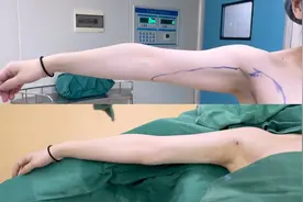 手臂松弛拜拜肉，非手术和手术的多种方法，一起来探讨图片