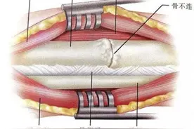 骨折康复后为什么还会疼痛，这正常吗？图片