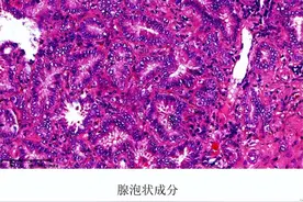 浸润性肺腺癌能治愈吗？了解不同病理亚型肺腺癌的治愈率图片