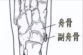 脚背痛了好久却不知道原因？了解一下足副舟骨炎图片
