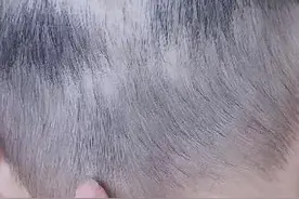 惊！宝宝后脑勺有一个会移动的小疙瘩图片