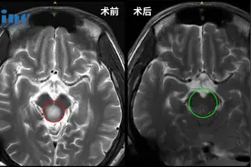 早手术会刺激低级别胶质瘤生长或恶化？图片
