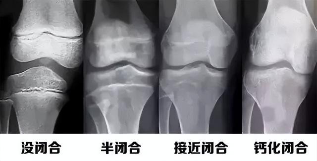 男孩女孩的骨骺线一般几岁闭合？