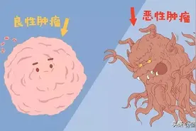 肿瘤界争议：3类癌症不致命，或不该成为“癌”，不要过度治疗图片