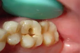 做了根管治疗的牙还疼，牙科医生：警惕这三种原因！图片