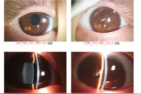 4岁女童先天没瞳孔，专家妙手“点睛”图片