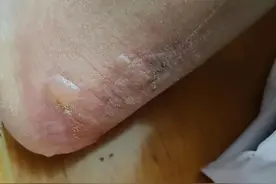 脚后跟红肿起疱，怎么了？图片