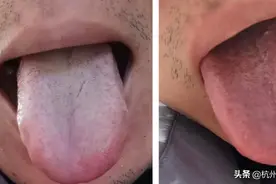 脾胃好不好，舌头最清楚！舌苔长期白厚要注意图片