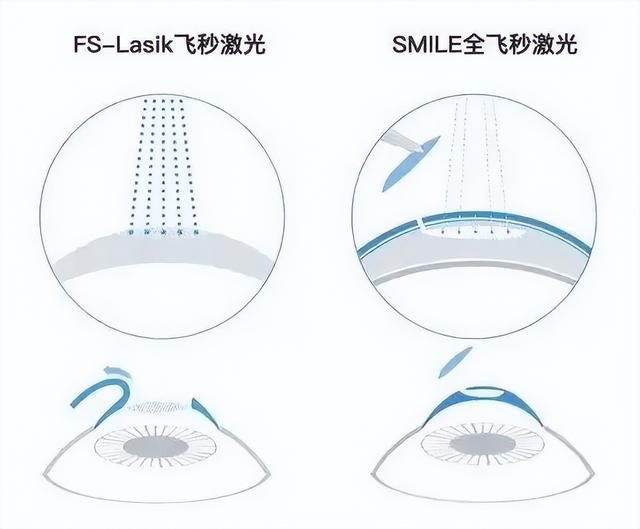 全飞秒 vs 半飞秒 区别就看这两点