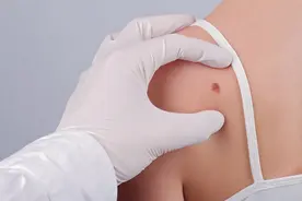 身上长了很多小红痣？是得了肝病的“信号”？这2个原因也有可能图片