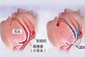 打鼾怎么办？图片
