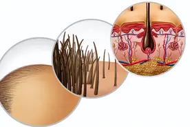 头皮上经常长脓包和疙瘩，是咋回事？医生：3种病要考虑在内图片