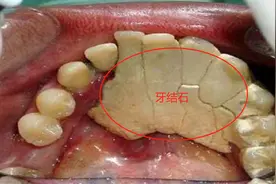 牙结石终于被刷掉了！原来靠的是这几招，掌握后牙结石一刷就掉！图片