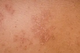 有一种剧痛叫“带状疱疹”，专家：4类人容易被盯上，及时治疗图片