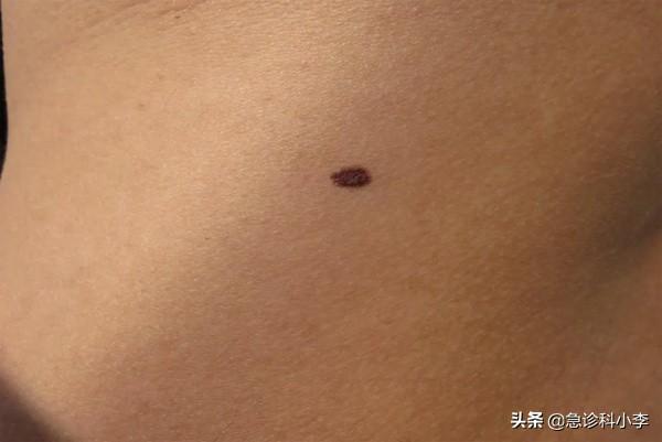 手上长了很多小红点