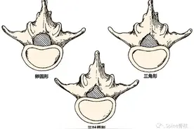 侧隐窝 (lateral recess)图片