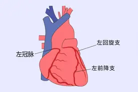 冠脉造影是确诊冠心病的标准，为什么不能轻易做？有哪些危害？图片