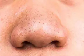 鼻子黑头不断，其实多是寒淤所致，暖宫才是最好的美容方！图片