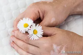 他克莫司和复方甘草酸苷，是如何治疗白癜风的？医生一文讲清楚图片