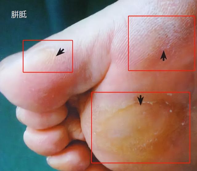 看图，猜猜哪个是鸡眼