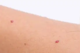 身上长出不痛不痒的血痣，别大意，1张方子疏肝解郁，帮你调理图片