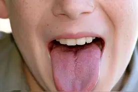 舌头中间有裂纹，是身体哪里出现了问题？图片