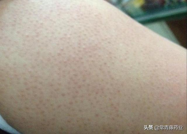 胳膊突然摸起来有鸡皮肤
