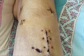 胫骨腓骨骨折髓内钉术后第21天图片