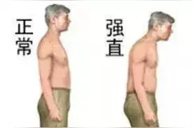 年纪轻轻腰疼，小心患上“明星病”图片