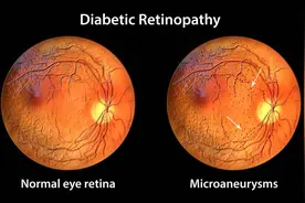 糖尿病人，失明的4个原因，你防住了吗？眼病分6期，你在哪一期？图片