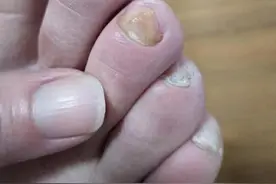 如何轻松根除灰指甲？图片