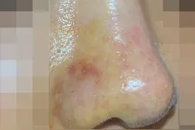 三甲医生坦白局：“玻尿酸填充”他们可能不会告诉你的“后遗症”图片