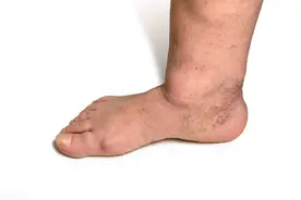 老年人腿脚水肿别忽视！需警惕的5种疾病，逐条为您讲清楚图片