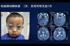软脑膜动静脉瘘（血管畸形）介入治疗病例图片
