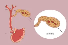 胆囊息肉容易发生癌变吗？要想治，只能连胆囊一起摘除吗？图片