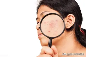 如何有效地治疗青春痘 皮肤科医生教你图片
